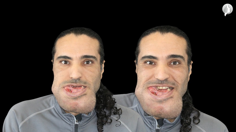 A case of osteosarcoma in a 37-year-old man who had been operated five years ago to remove fibrous dysplasia from the right lower jaw which recurred and transformed into osteosarcoma.