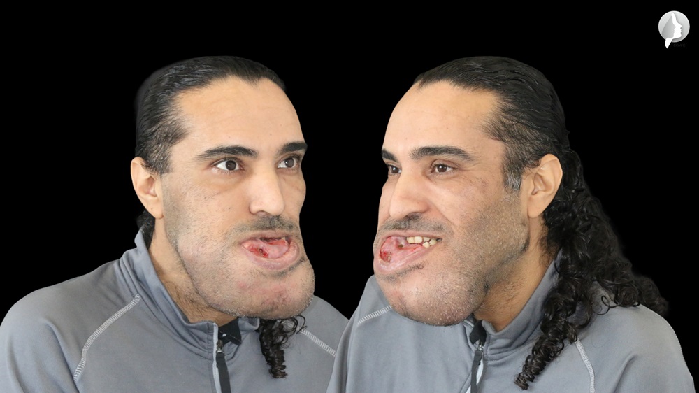 The size of the lesion was such that the patient had difficulty feeding and breathing.