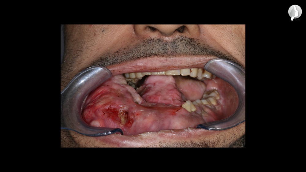 He could not open his mouth and his tongue was indistinct.