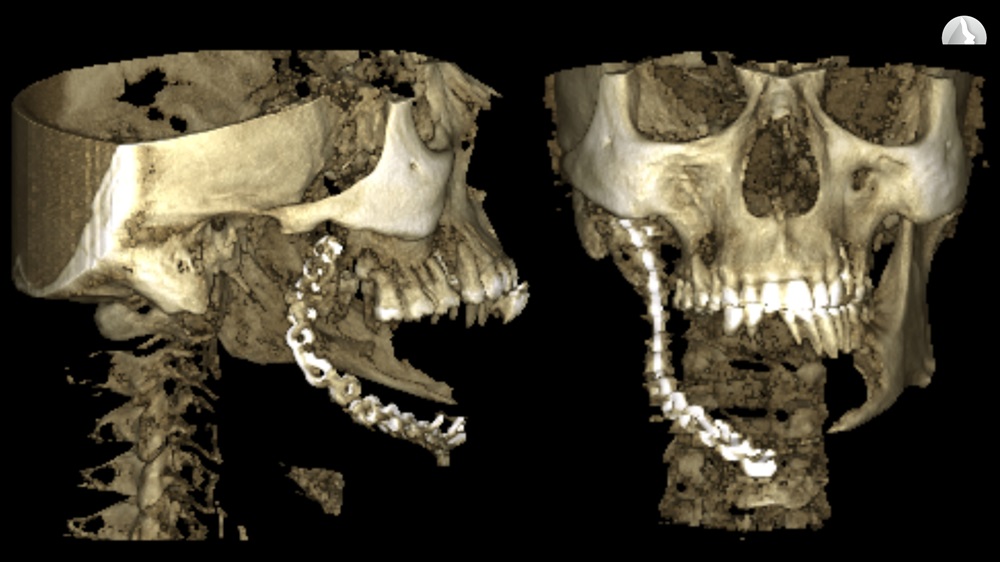 3D visualization with the reconstruction plate was used in the previous operation