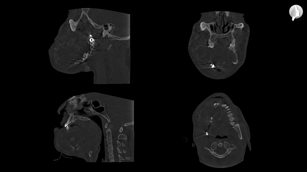 From the axial sections you can distinguish the size of the tumor and the convergence of the airway.