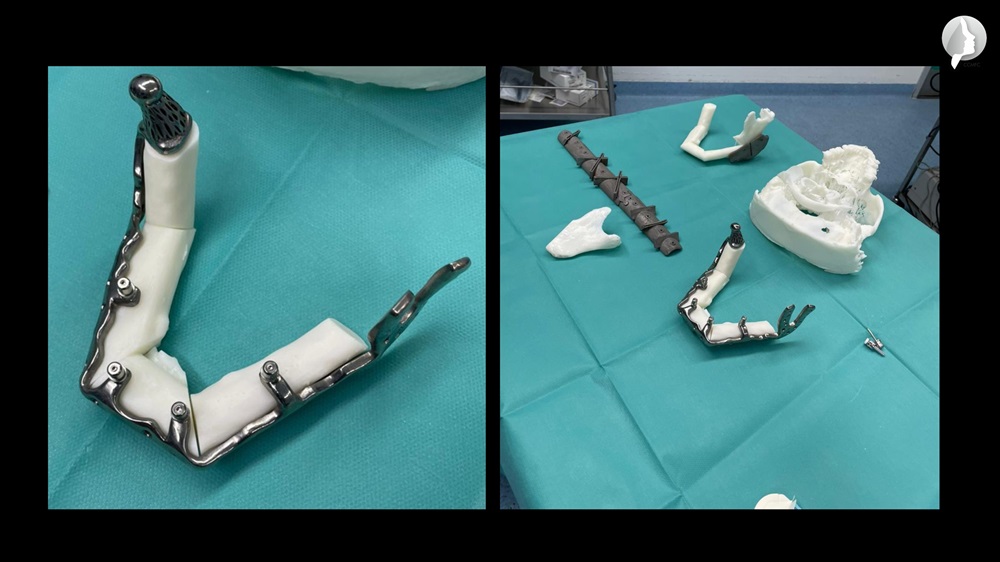 Due to the seriousness of the situation, it was decided to immediately deal with a prefabricated custom-made implant for the replacement of the lower jaw using a vascularized fibula flap and skin which was adapted to the implant which also brought the infrastructure for immediate prosthetic restoration.