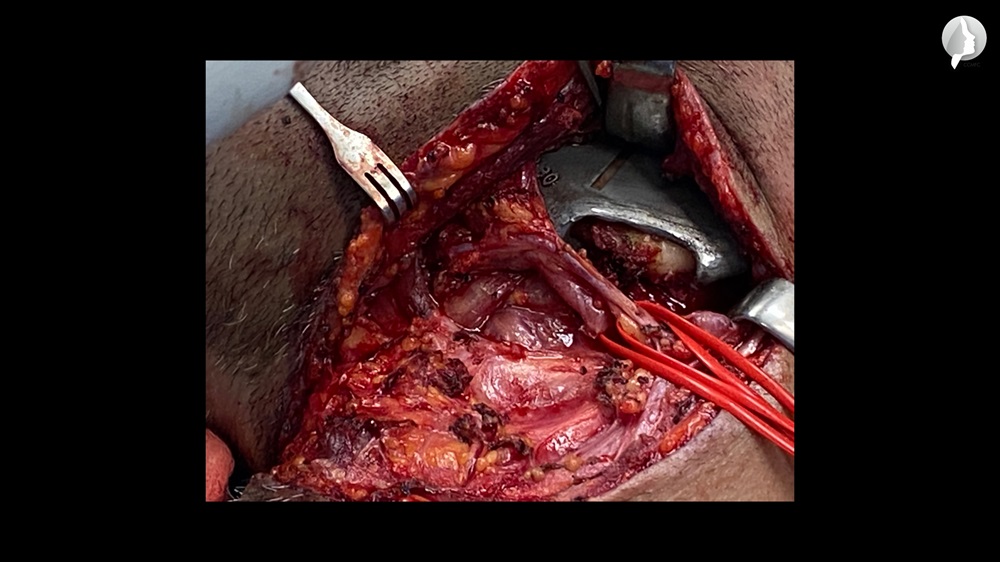 The prepared vessels for the anastomosis