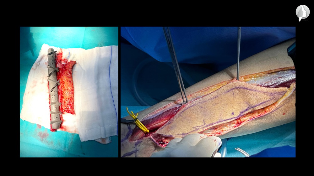 The palpable fibula and skin flap