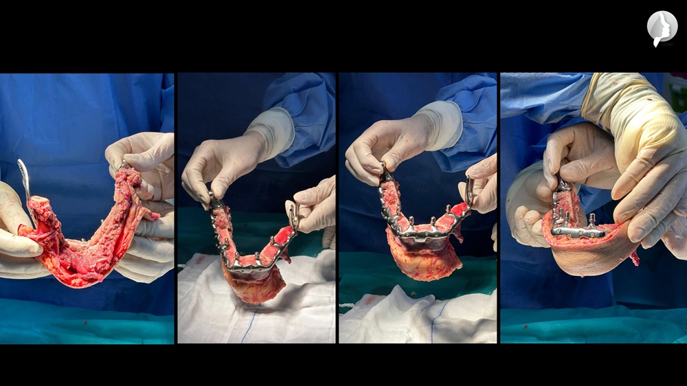 Adaptation of the flap to the implant