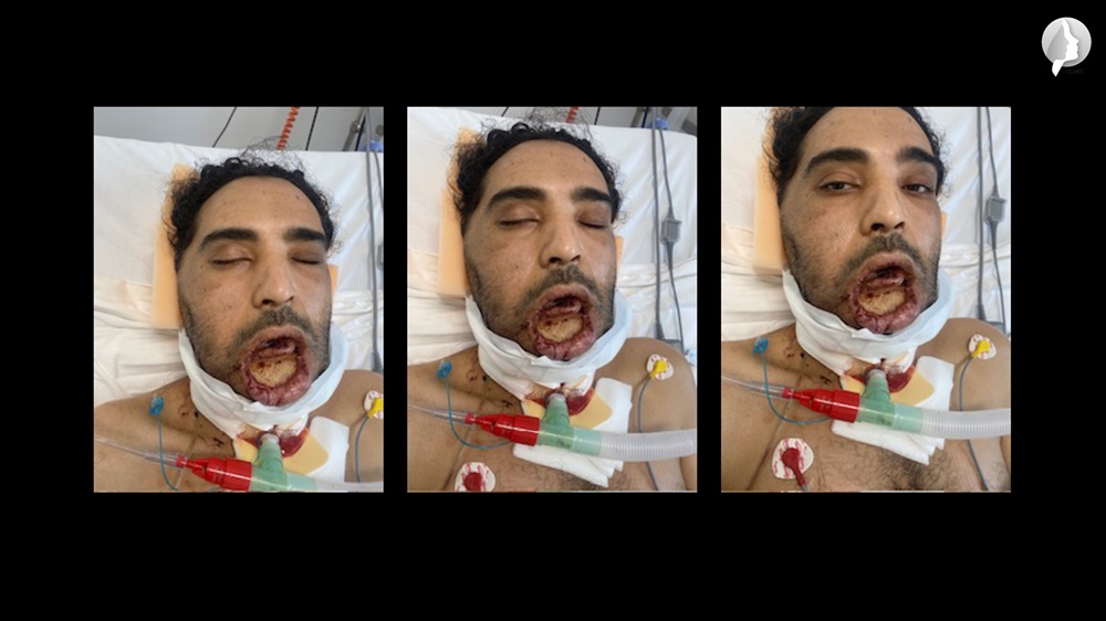 The patient on the first postoperative day