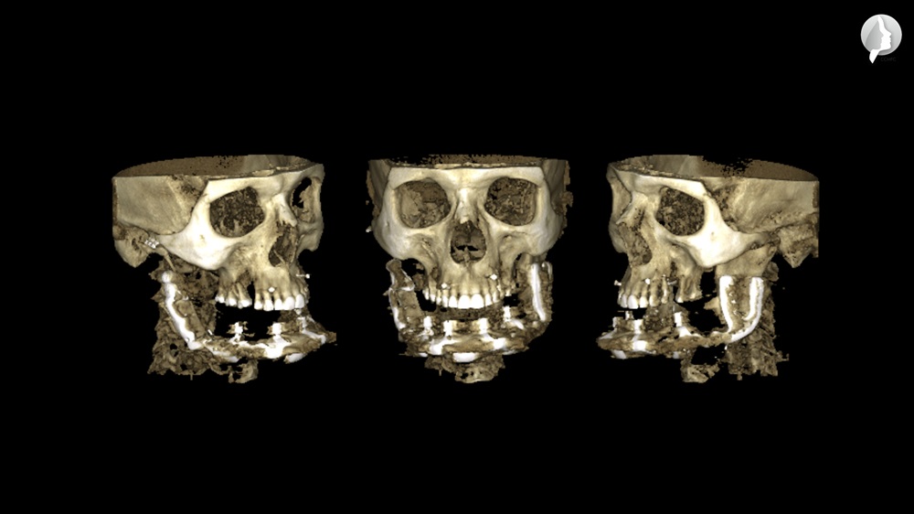 Postoperative 3DCBCT
