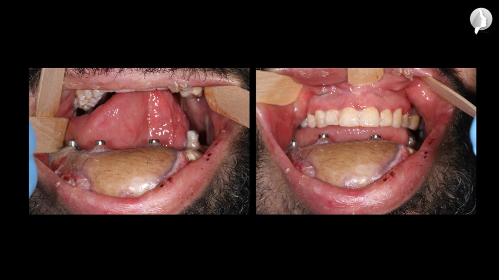 The patient with open and closed mouth. We see the massive skin flap that due to the urgency we were not able to use the Forte and Integra technique